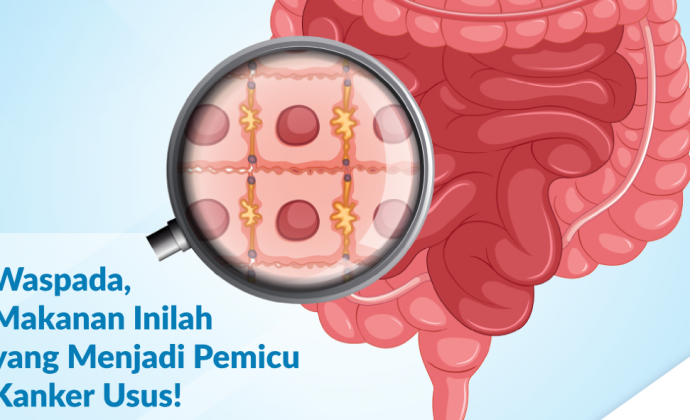 Waspada, Makanan Inilah yang Menjadi Pemicu Kanker Usus! - PB PEGI